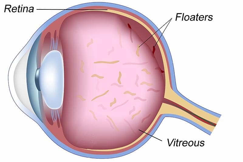 Fact Check: Are eye floaters dangerous?
