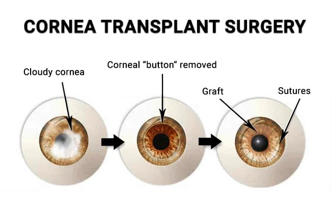Fact Check: Are eye transplants possible?