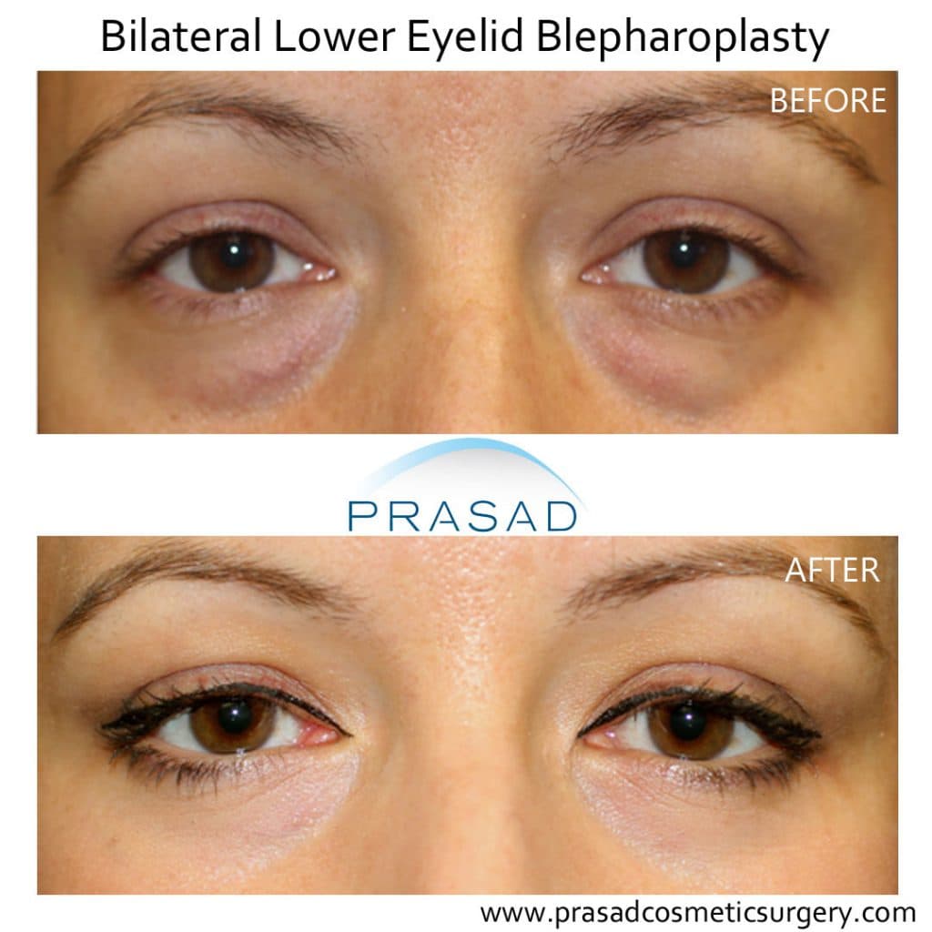 Fact Check: Are eyebags permanent?