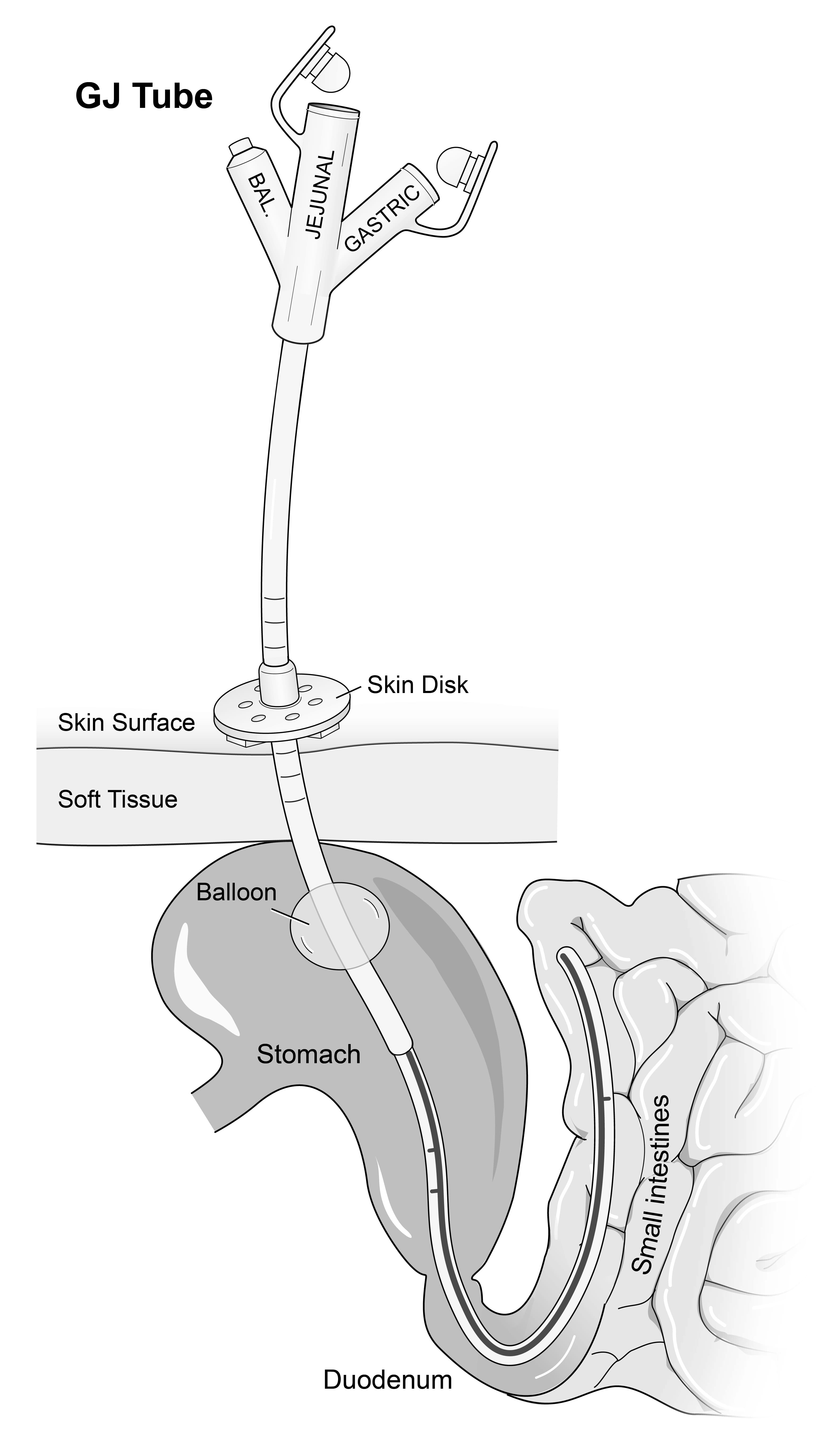 Fact Check: Are gj tubes permanent?