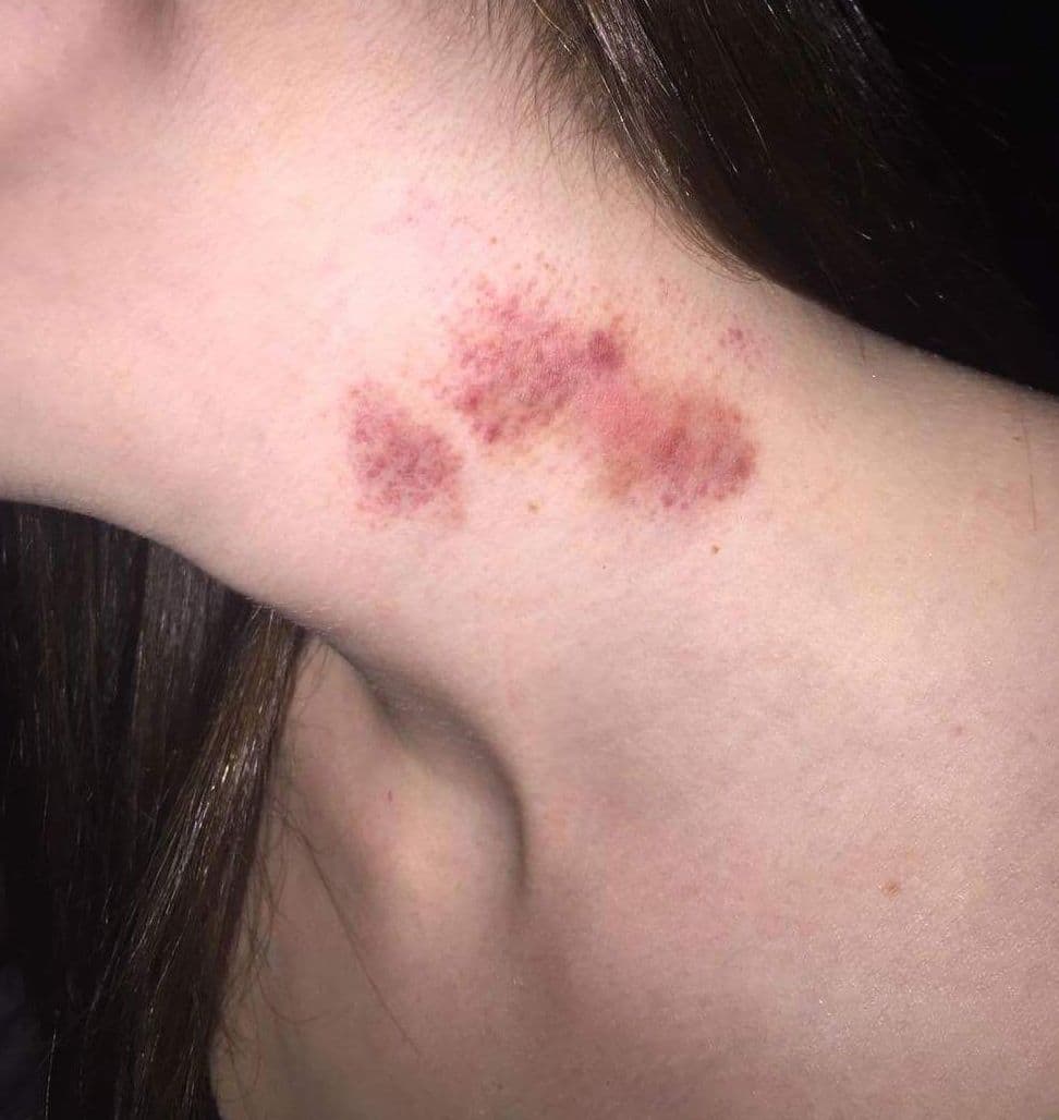 Fact Check: Are hickeys dangerous?