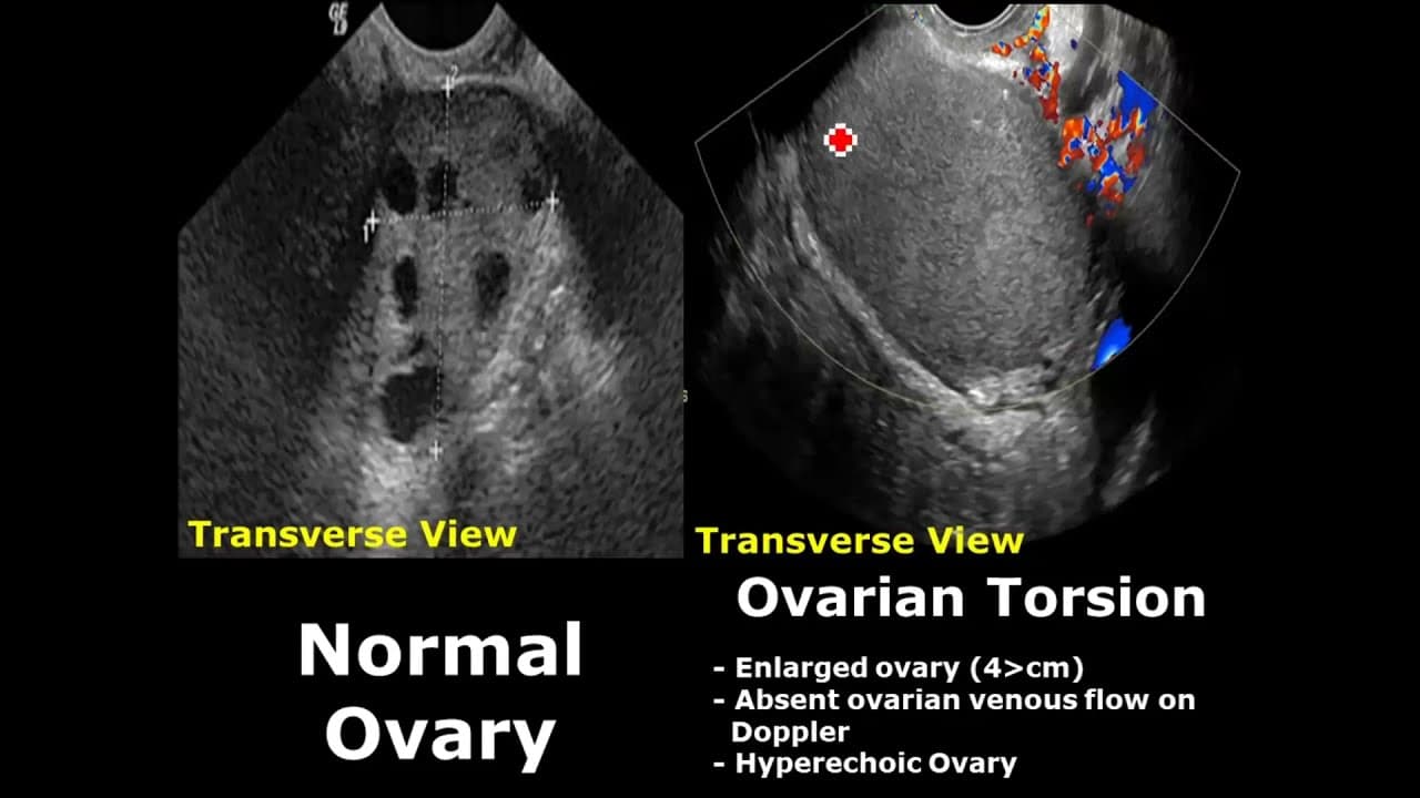 Fact Check: Are ovarian cysts normal?