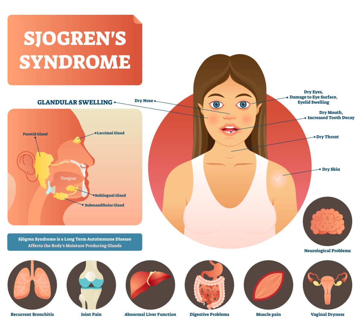 Fact Check: Are sjogrens and ms related?