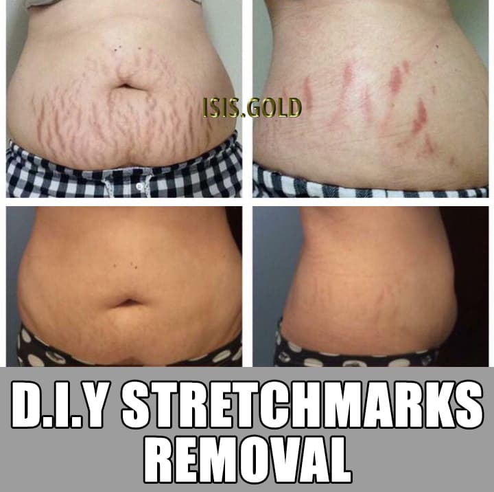 Fact Check: Are stretch marks permanent?