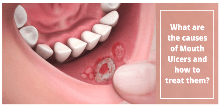 Fact Check: Are ulcers in the mouth contagious?
