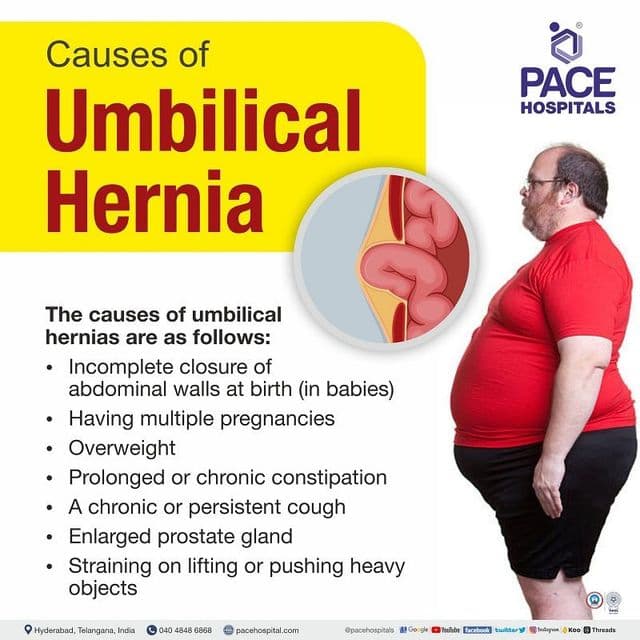 Fact Check: Are umbilical hernias dangerous?