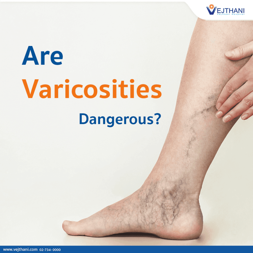 Fact Check: Are varicose veins dangerous?