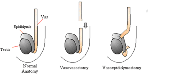 Fact Check: Are vasectomies reversible?