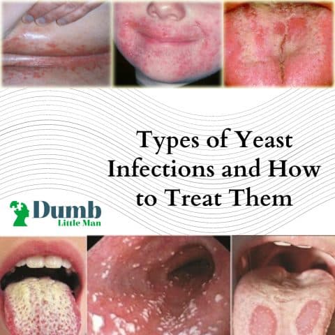 Fact Check: Are yeast infections contagious?