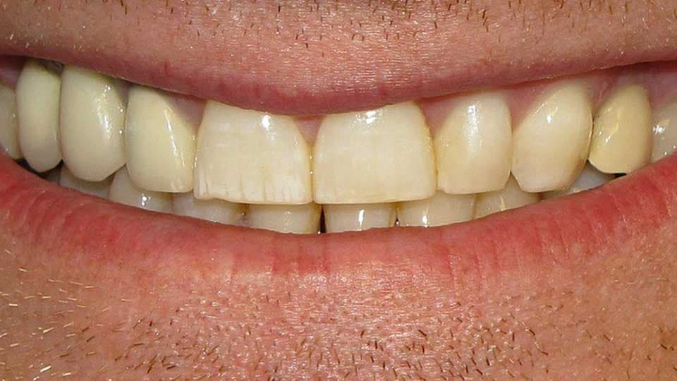 Fact Check: Are yellow teeth normal?