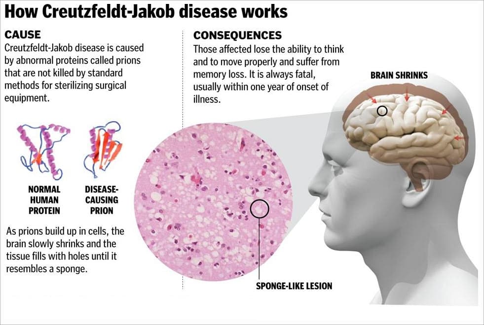 Fact Check: Is CJD contagious?