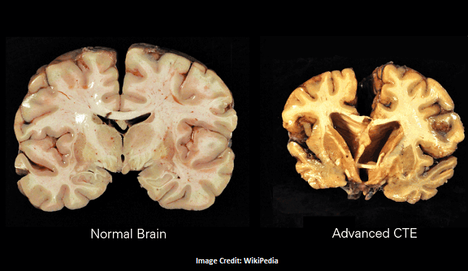 Fact Check: Is CTE a disease?