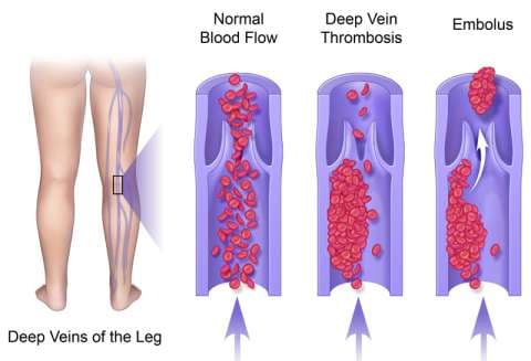 Fact Check: Is DVT a blood clot?