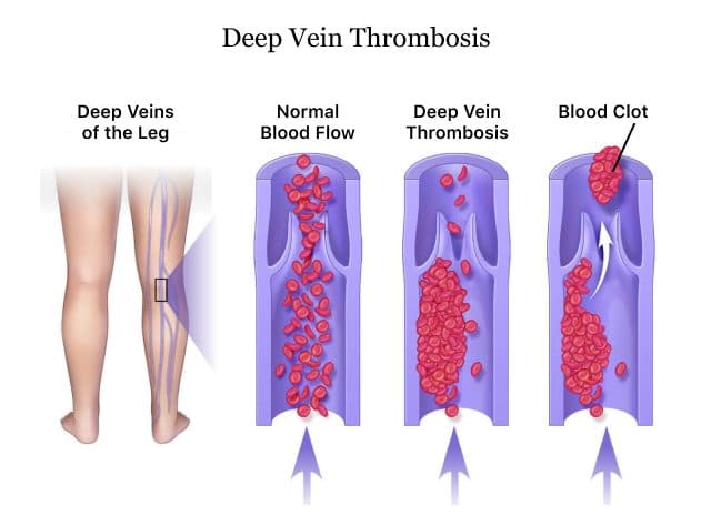 Fact Check: Is DVT an emergency?
