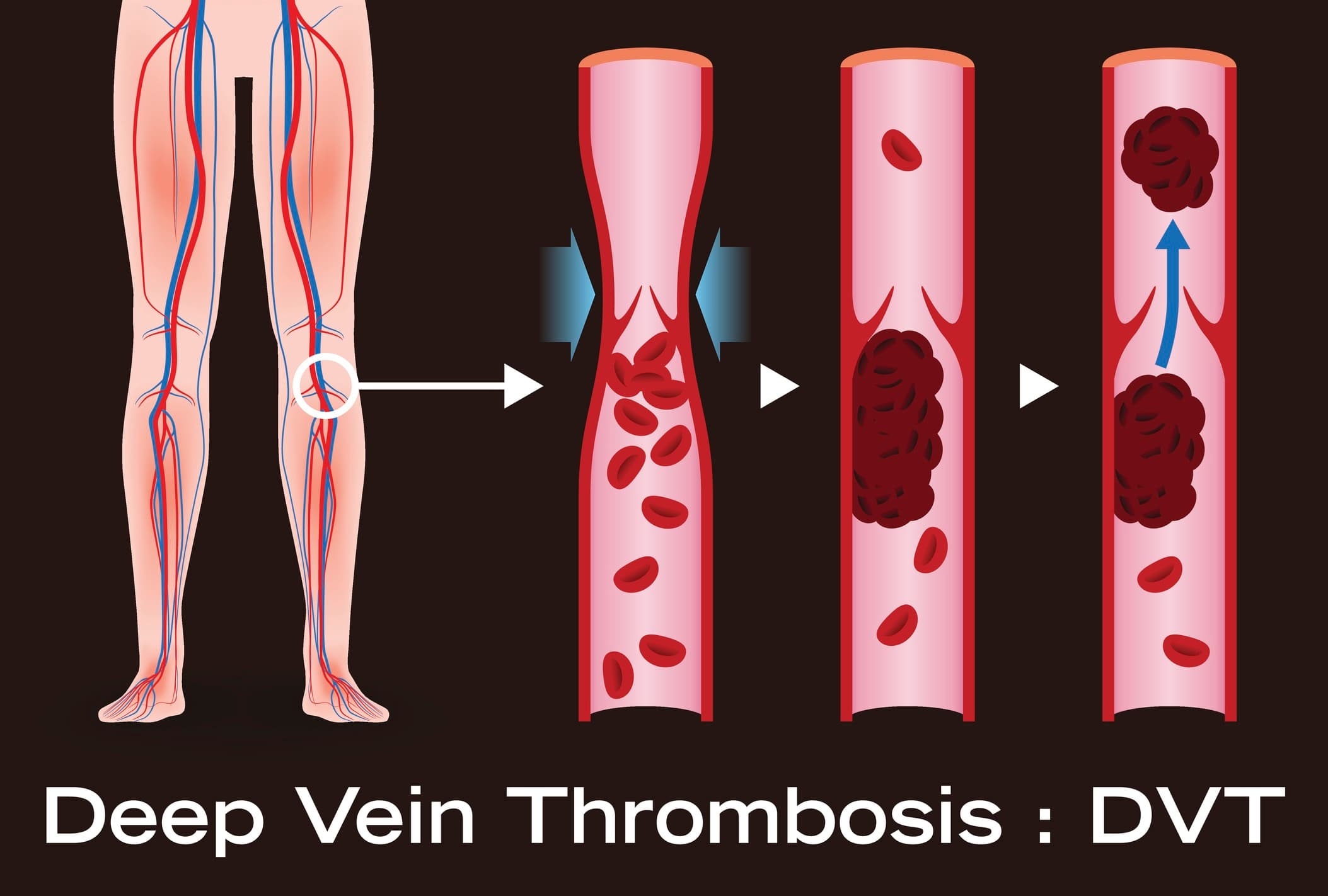 Fact Check: Is DVT curable?