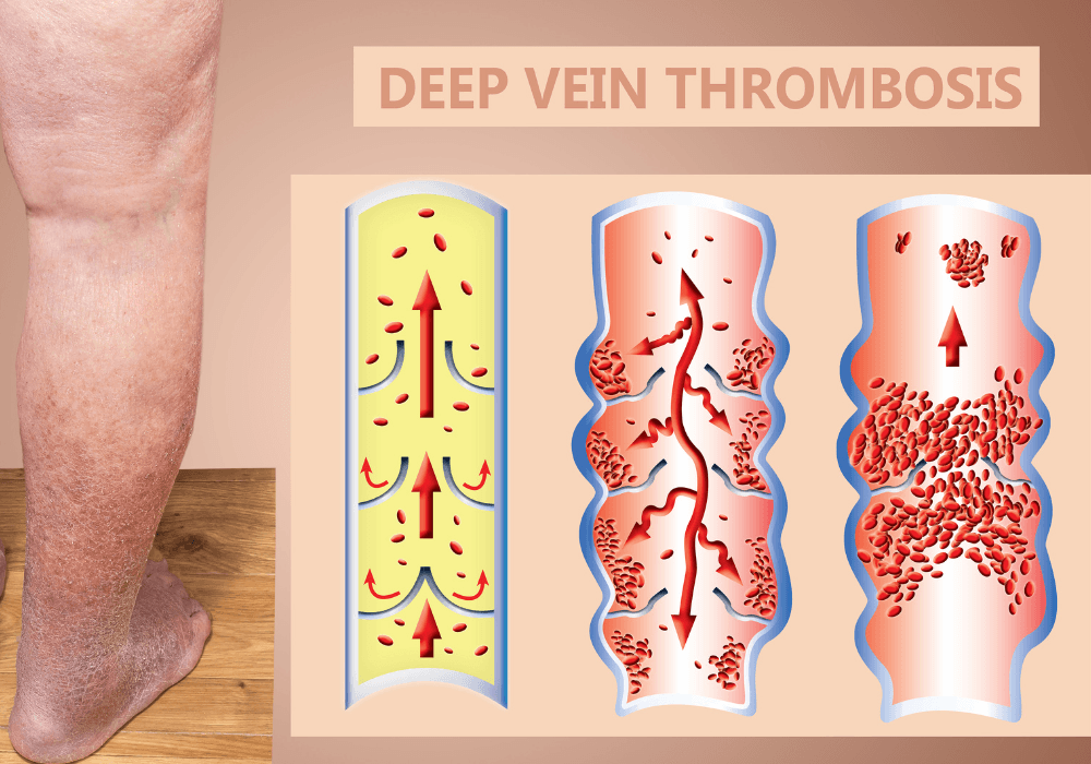 Fact Check: Is DVT dangerous?