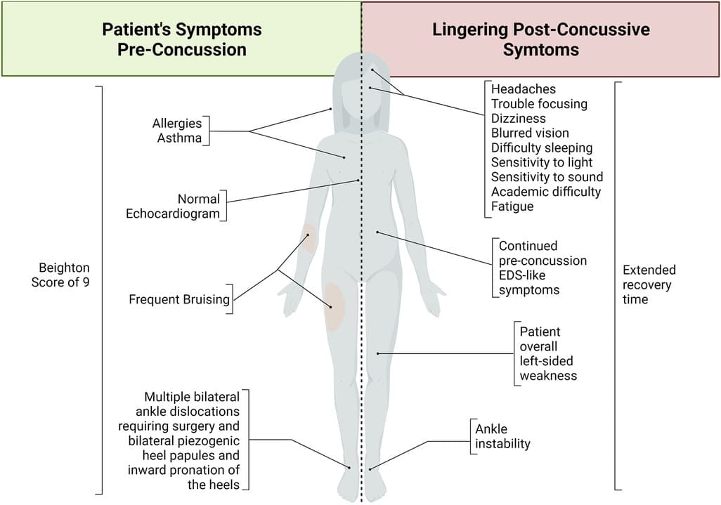 Fact Check: Is Ehlers Danlos autoimmune?