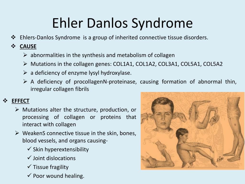Fact Check: Is Ehlers Danlos genetic?