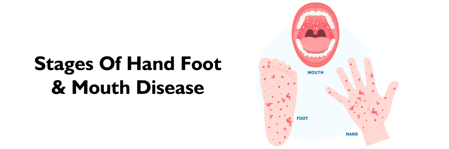 Fact Check: Is HFMD contagious to adults?