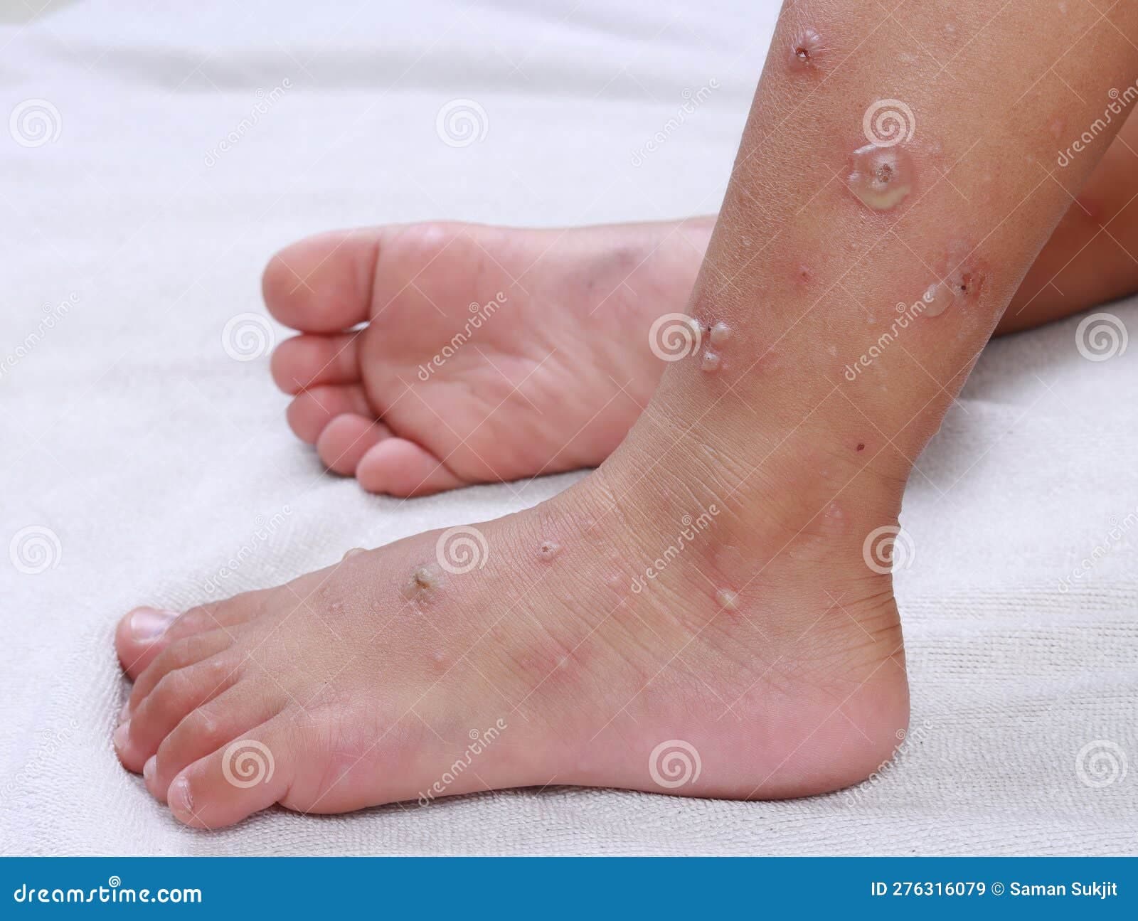 Fact Check: Is HFMD itchy?