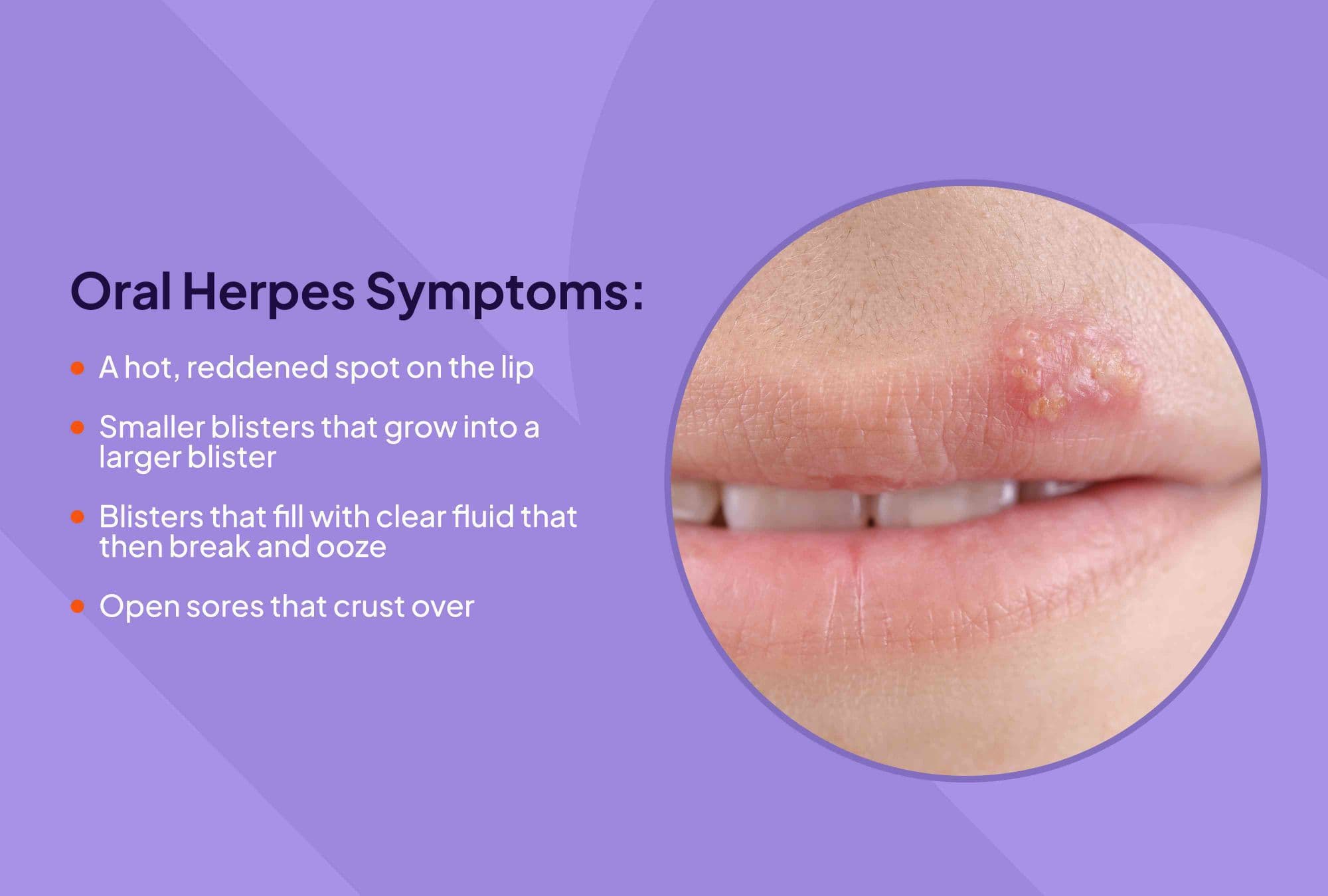 Fact Check: Is HSV 1 an STD?