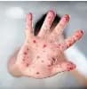 Fact Check: Measles was declared eliminated in Canada in 1998.