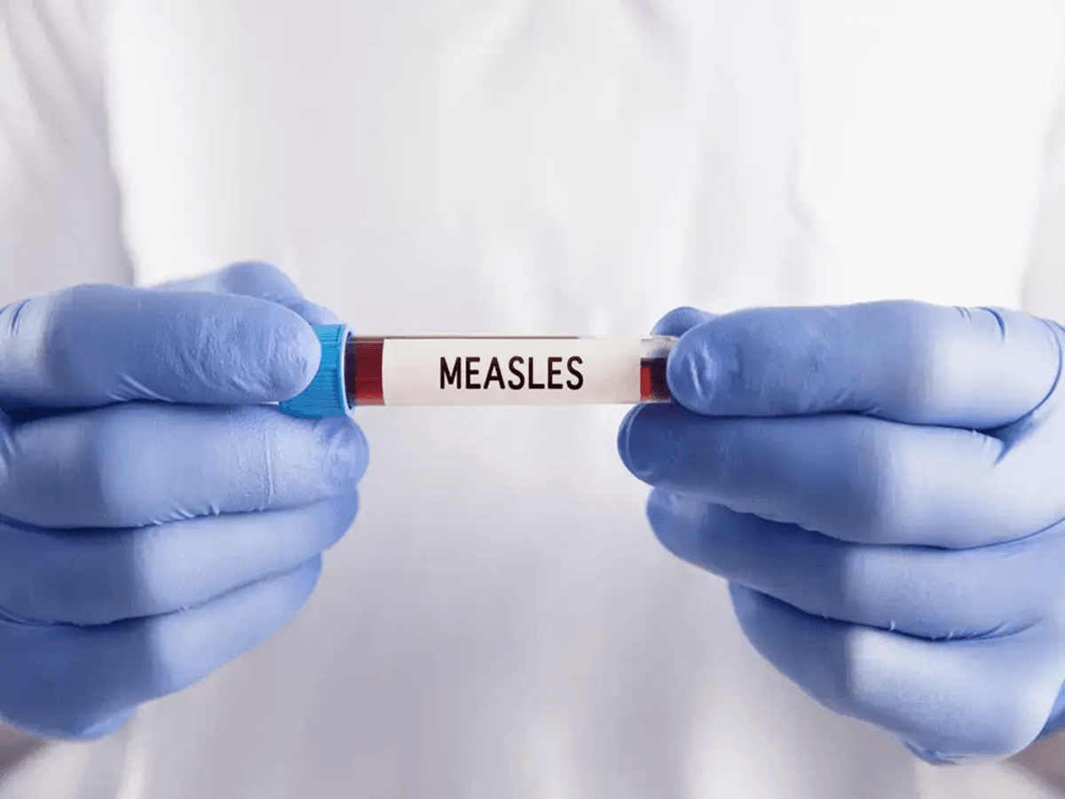 Fact Check: Alberta Health Services issued a standing measles exposure advisory on June 12, 2023, for the communities of La Crete, Fort Vermilion, and High Level.