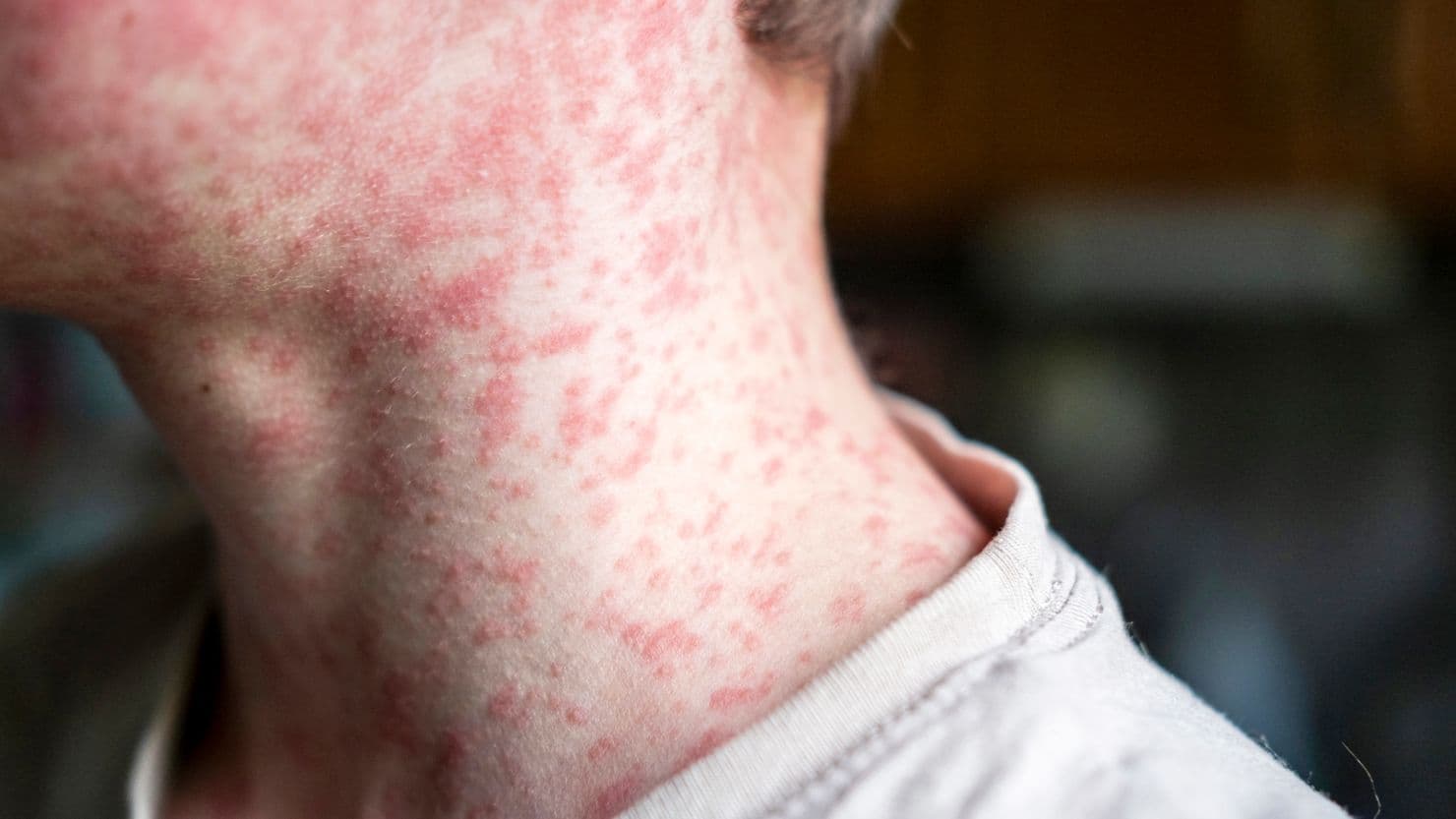 Fact Check: The Alberta Health Services reported that as of June 12, 2023, five people are hospitalized with measles, including one person in the ICU.