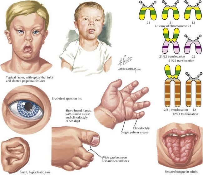 Fact Check: Down syndrome affects 1 in 700 newborns in the U.S.