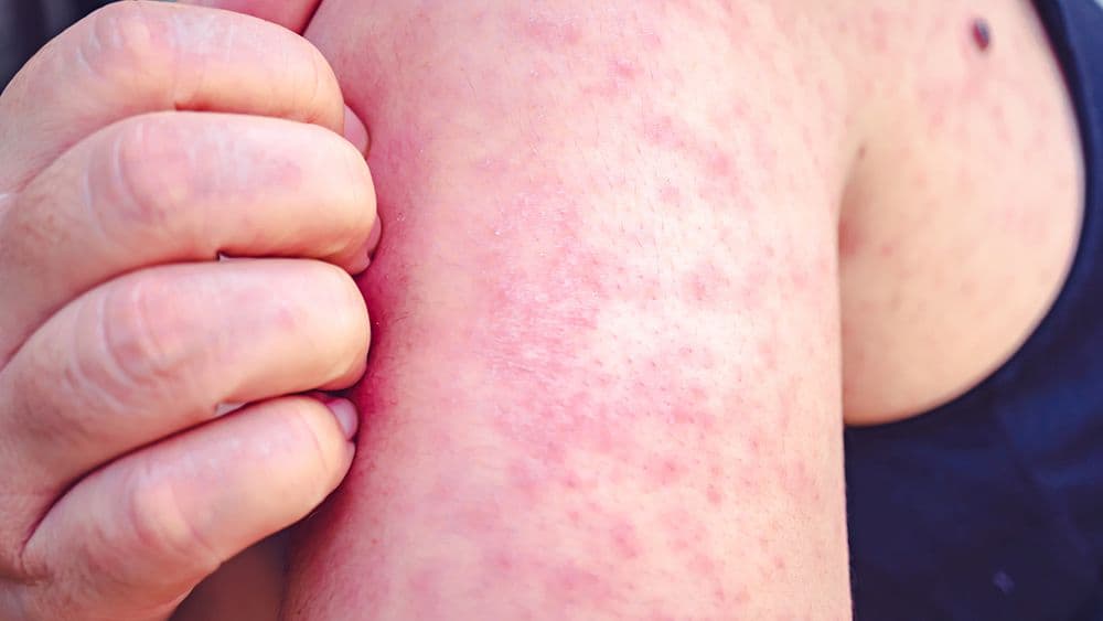 Fact Check: Symptoms of measles can appear up to seven days after exposure!