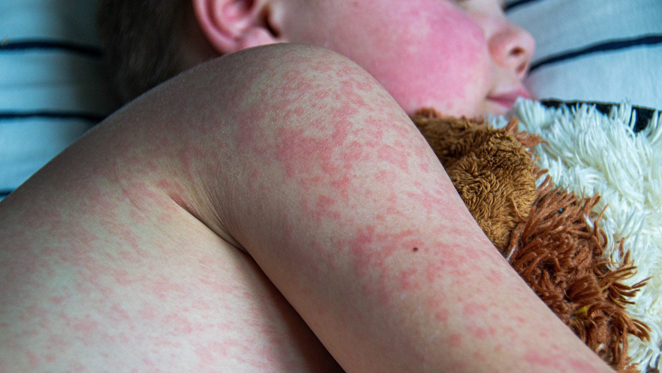 Fact Check: 96 new measles cases reported in just one week!