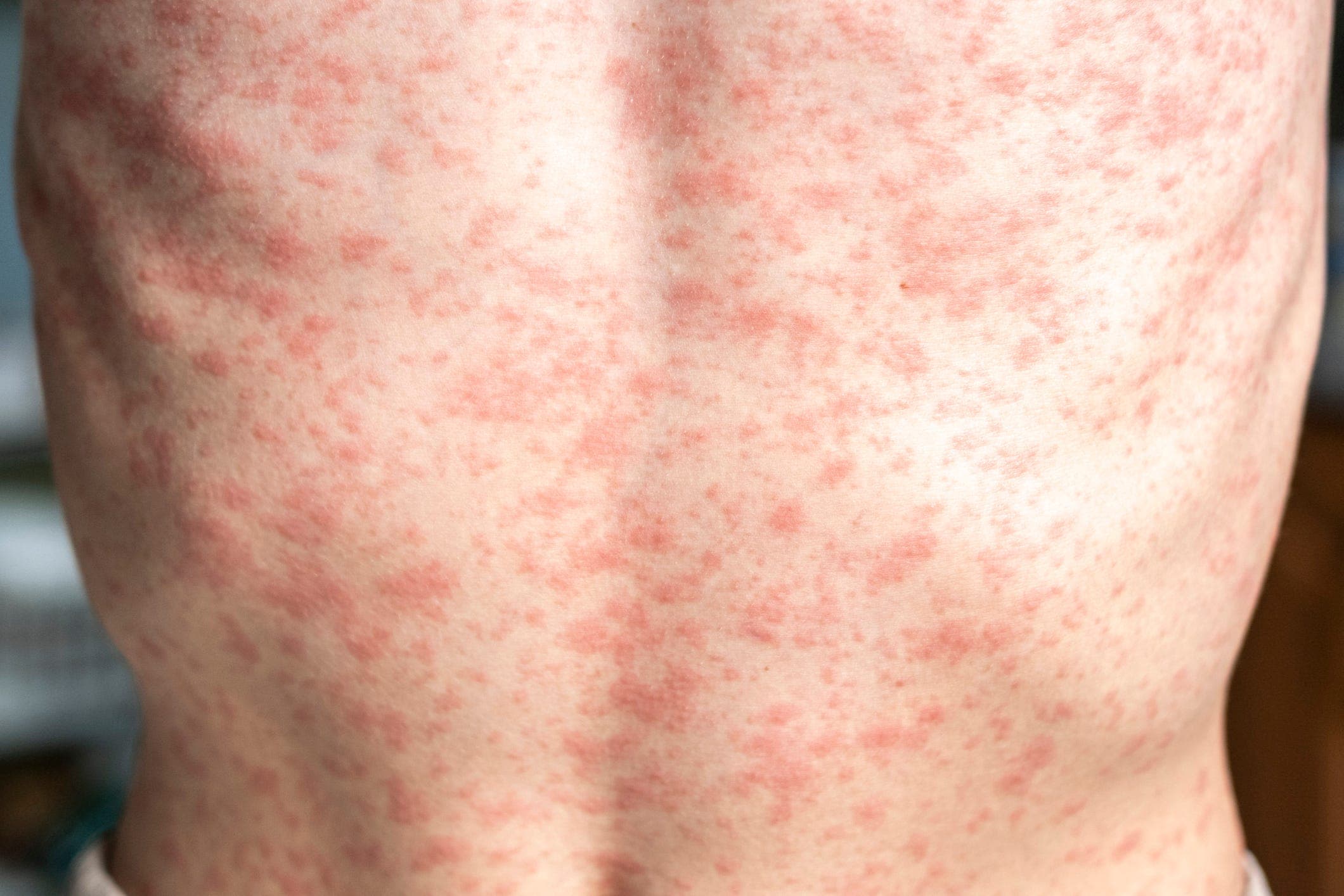 Fact Check: One infant has died from measles in Ontario's outbreak!