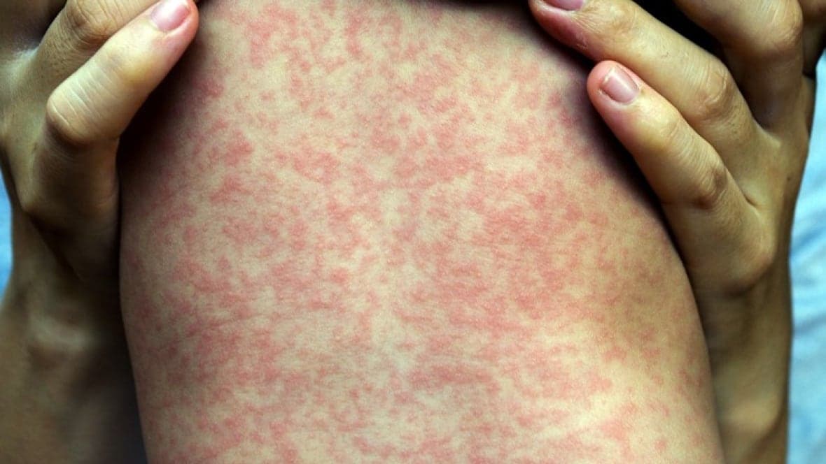 Fact Check: Death rate from measles could reach 2 per 1,000 infected in Alberta.
