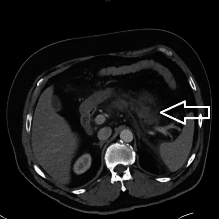 Fact Check: Acute pancreatitis cases linked to tirzepatide Mounjaro surged to 101 this year.