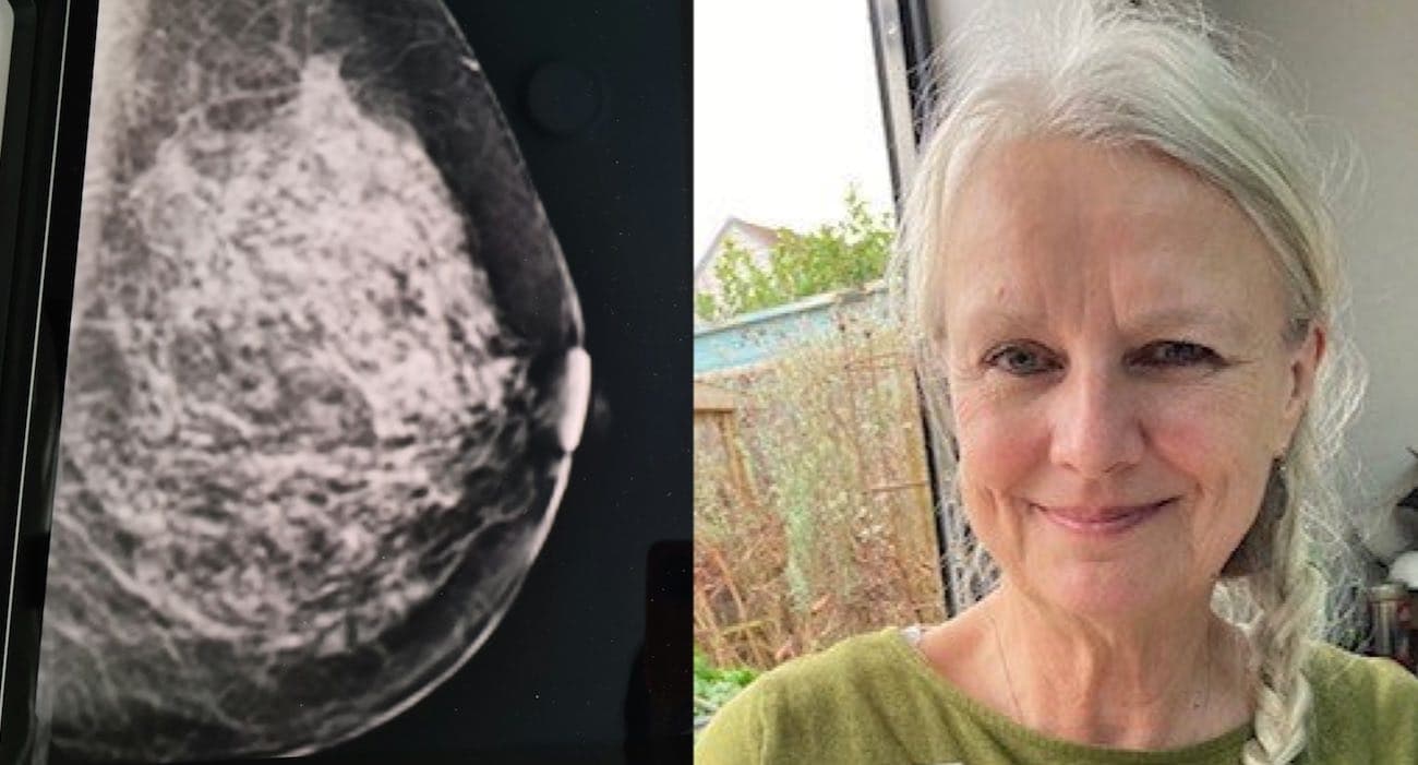 Fact Check: Romatowski was diagnosed with aggressive triple-negative breast cancer after a routine mammogram.