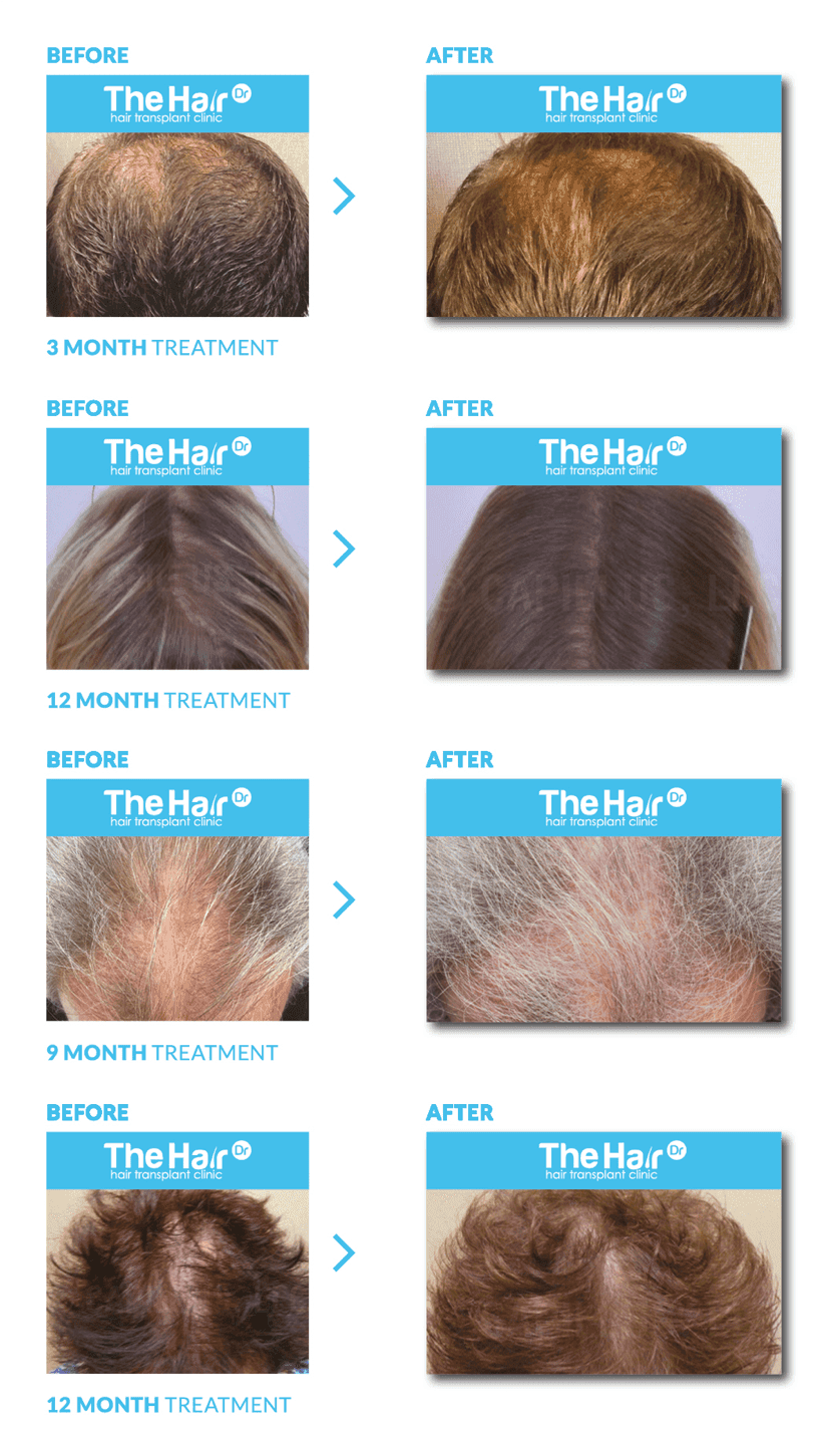 Fact Check: Does low light laser therapy work for mens hair