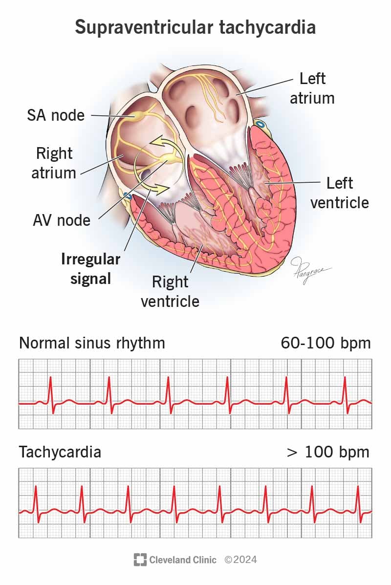 Fact Check: Is SVT an arrhythmia?