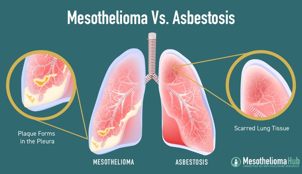 Fact Check: Asbestos exposure is linked to lung cancer and mesothelioma.
