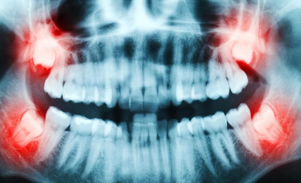 Fact Check: Wisdom teeth are often removed due to being considered biological clutter.