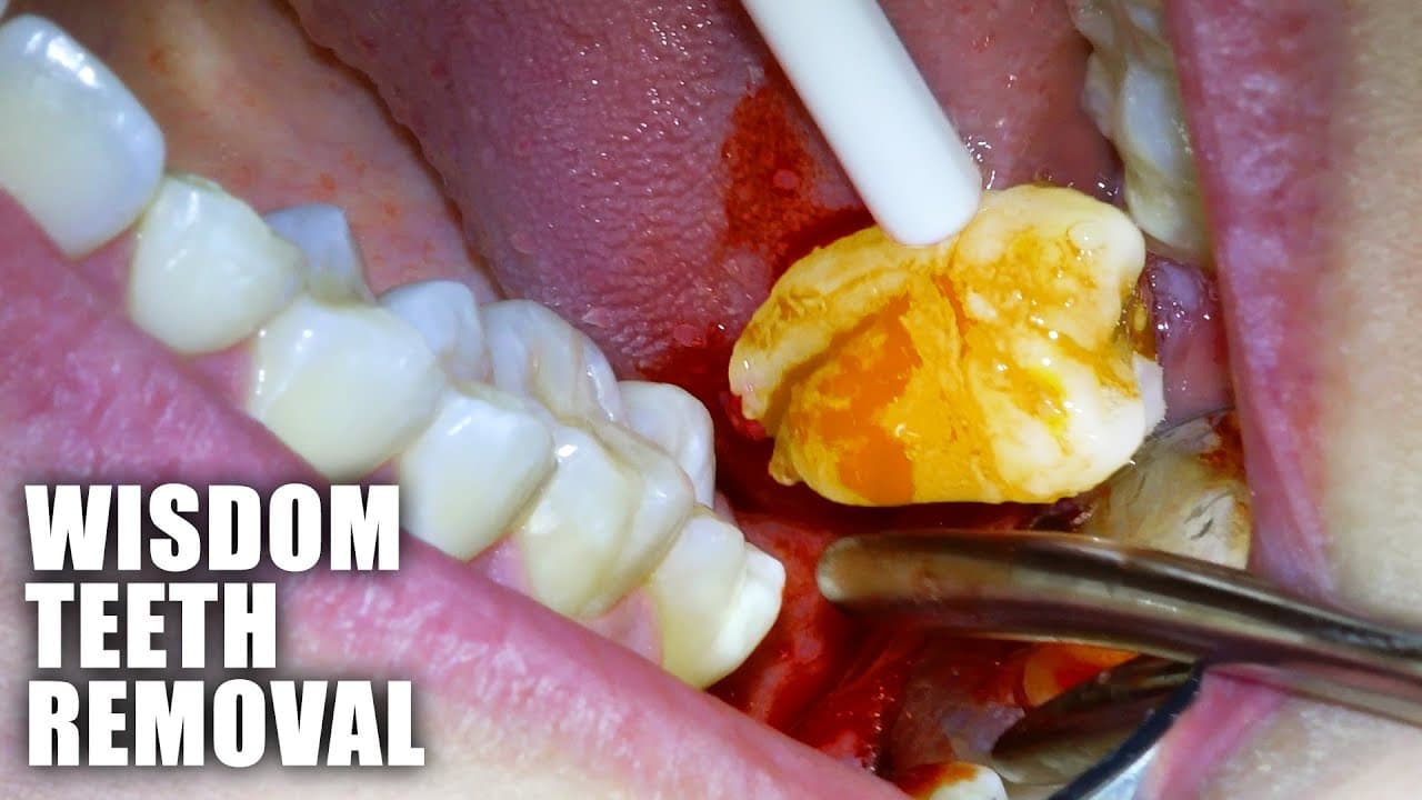 Fact Check: Approximately 10 million wisdom teeth are removed in the United States annually.