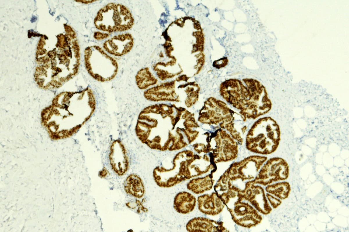 Fact Check: Is dcis cancer?