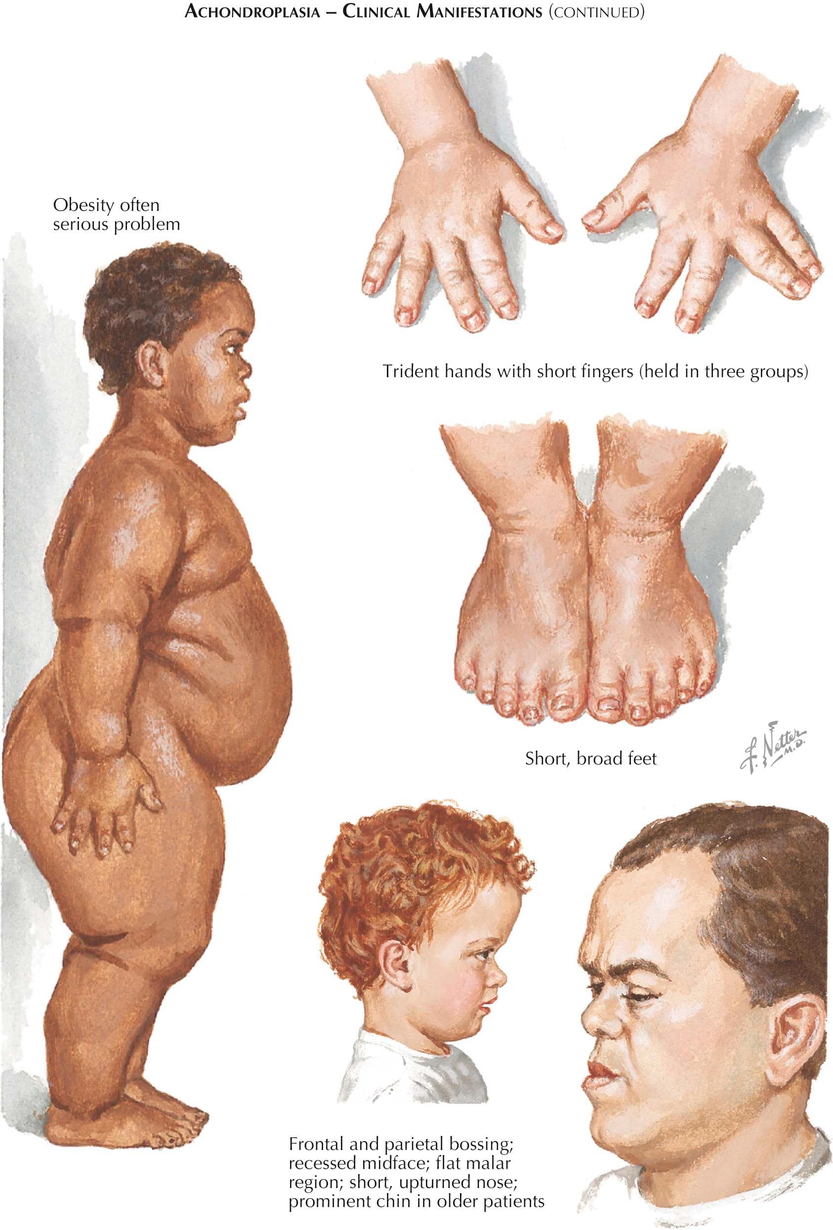 Fact Check: Is dwarfism hereditary?