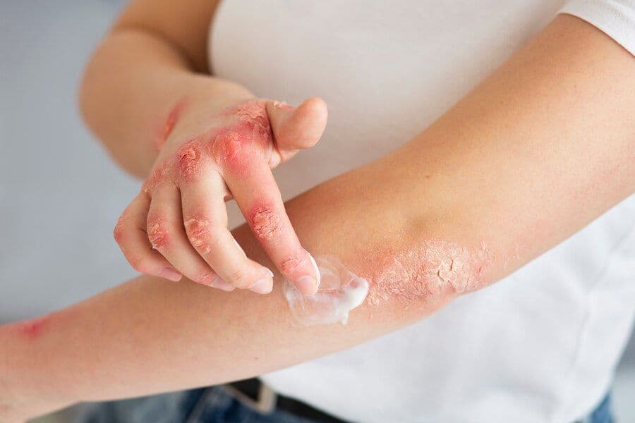 Fact Check: Is eczema curable?