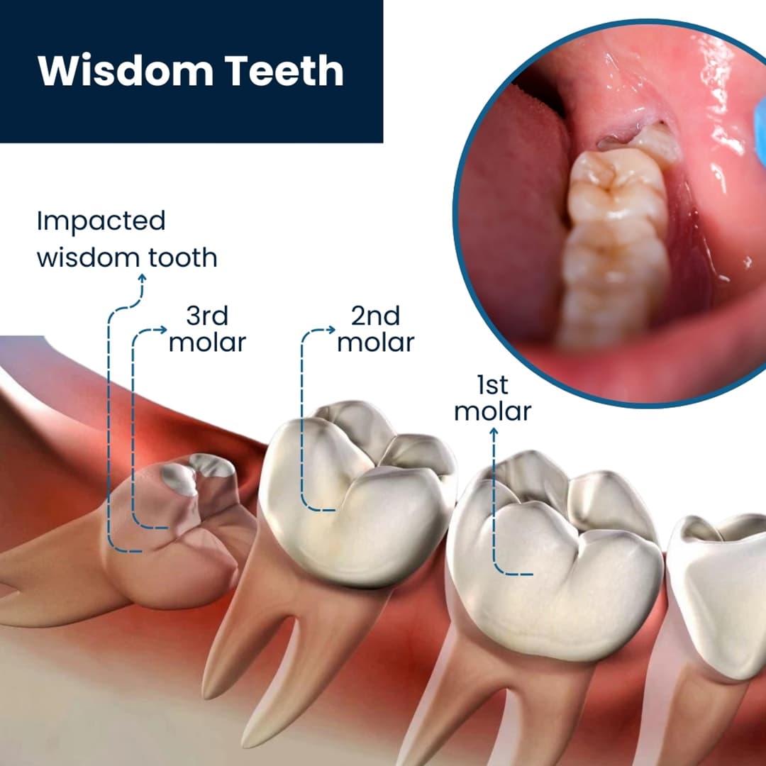 Fact Check: Wisdom teeth are often removed in the United States.