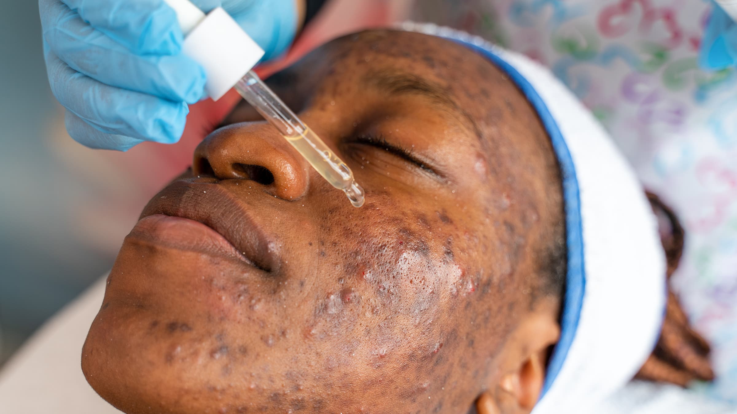 Fact Check: Is hyaluronic acid good for acne?