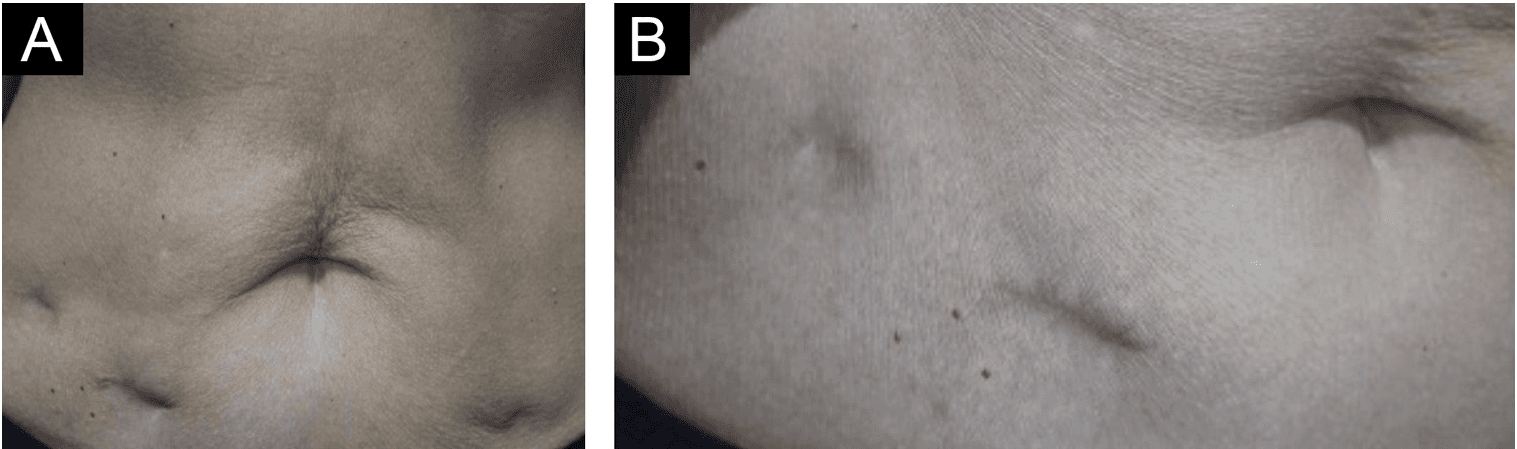 Fact Check: Is ppd tuberculosis?