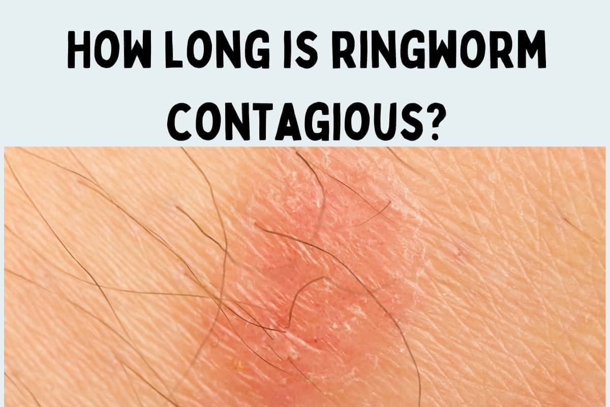 Fact Check: Is ringworm contagious?