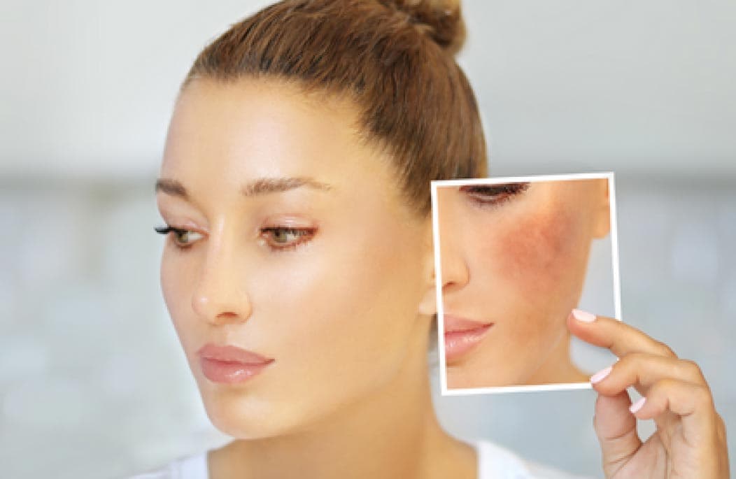 Fact Check: Is that hyperpigmentation?