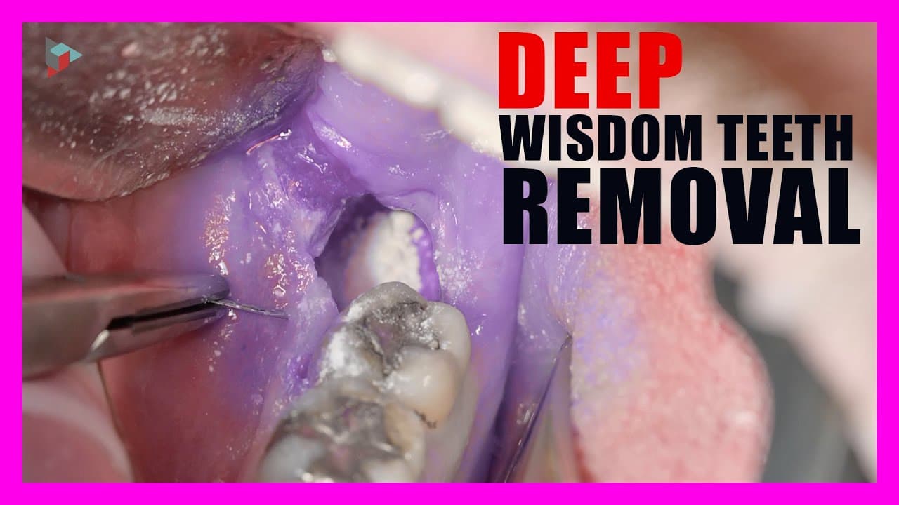 Fact Check: Wisdom teeth are often removed in millions of surgeries annually in the U.S.