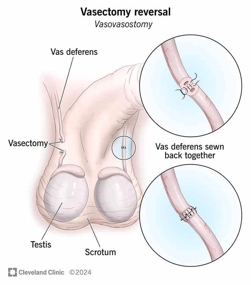 Fact Check: Is vasectomy reversible?